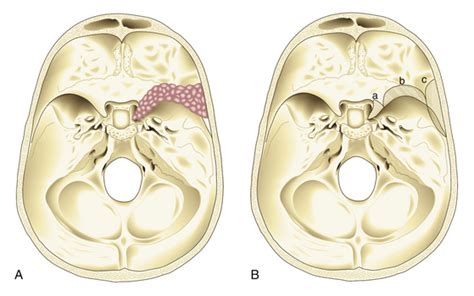 Surgical Management of Sphenoid Wing Meningiomas | Clinical Gate