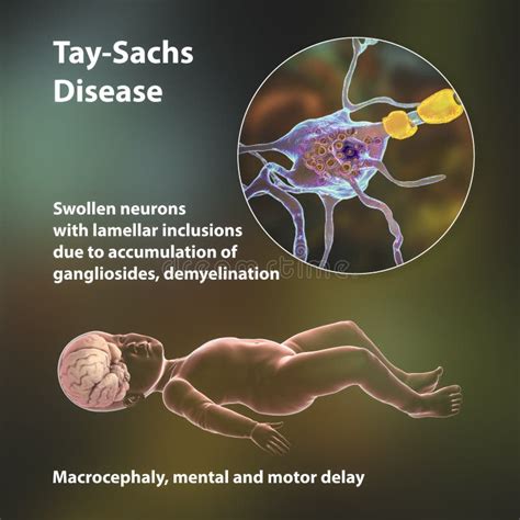 Tay-Sachs Disease, 3D Illustration Stock Illustration - Illustration of ...