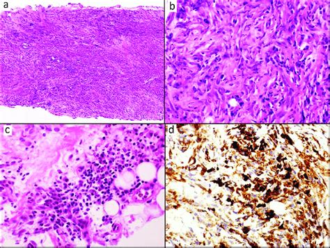 Histological analysis of the retroperitoneal mass biopsy. (a) Low-power ...