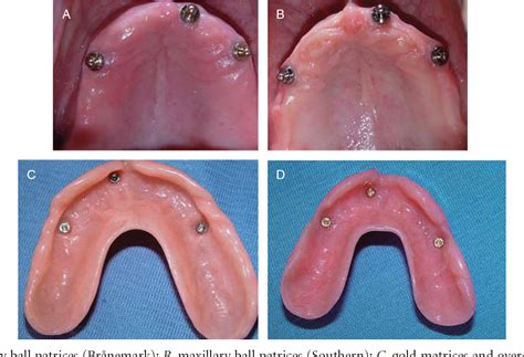 Figure 1 from Patient satisfaction with maxillary 3-implant overdentures using different ...