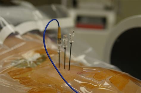 Radiofrequency Ablation | Nuerotomy | Arch Advanced Pain Management