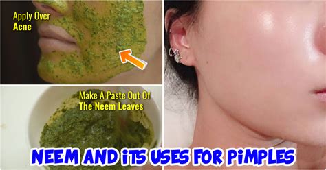 The Miraculous Benefits Of Neem Leaves For Skin Health – ArtOfBonsai.org