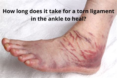 How To Heal A Torn Ankle Ligament Fast?-Great Running Advice