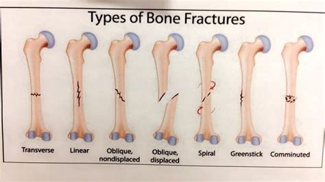 Types of Bone Fractures guide : coolguides | Types of bones, Bone fracture, Types of fractures