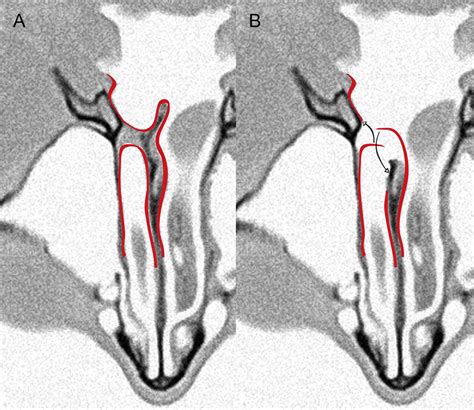 (a) Axial view of a unilateral right choanal atresia. Enhanced in red ...