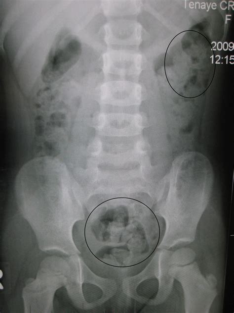 The Abdominal XRay: A relic or a reliable tool? — Taming the SRU