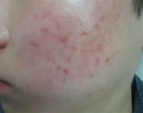 Severe smooth red acne scars :( - Hyperpigmentation - red/dark marks ...