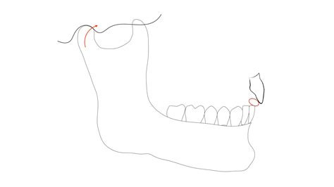 A Guide to Assessing and Treating the Anterior Open Bite