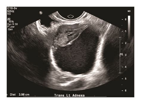 Ultrasound of the left adnexal mass in transview. | Download Scientific ...