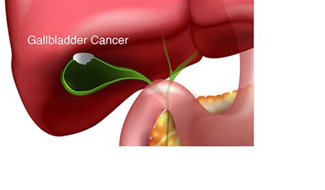 Gallbladder Cancer Causes and Early Symptoms