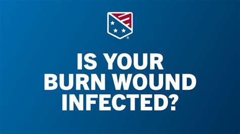 What an infected burn looks like, and how to tell if your burn is ...