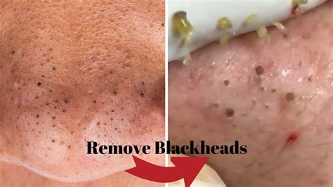 Remove Your Blackheads using these Techniques Naturally! Home Remedies - YouTube