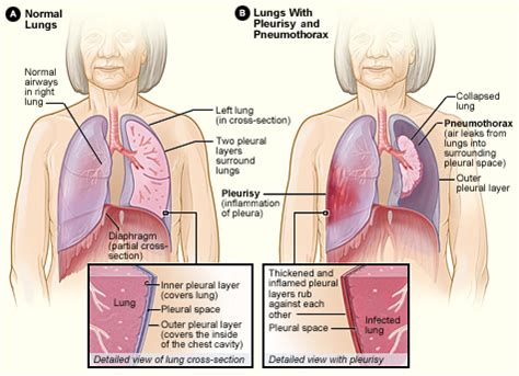 胸膜炎 - 维基百科，自由的百科全书