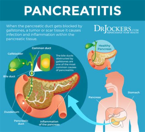 Pancreatitis: Symptoms, Causes and Natural Support Strategies