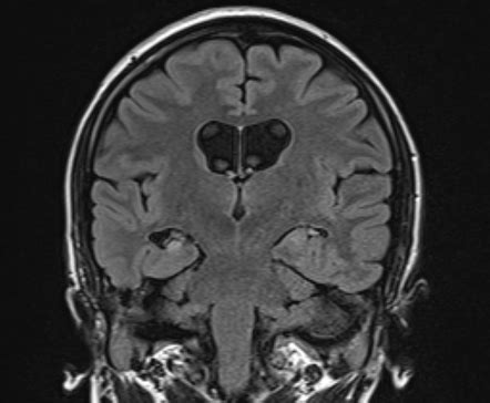 Medial Temporal Lobe Epilepsy