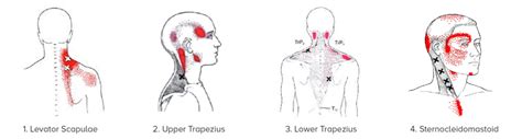 Neck Pain, Headaches & Migraines | Causes & Treatment | Dr. Chris Homan