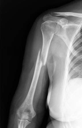 Humerus Fracture - Symptoms, Causes, Treatment & Rehabilitation