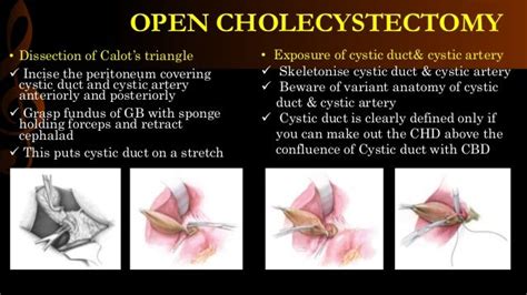 Open cholecystectomy/ operative surgery