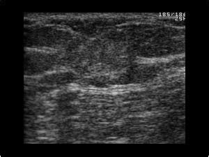 Breast and Axilla | 5.2 Malignant breast lesions : Case 5.2.5 Breast ...