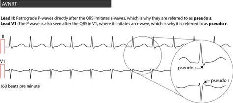 Pin on ECG