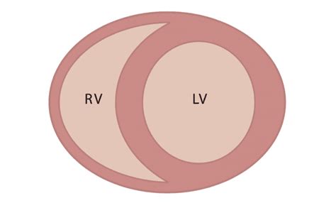 RV vs LV - REBEL EM - Emergency Medicine Blog