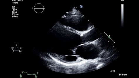 Ischemic Cardiomyopathy 2D Echocardiogram - YouTube