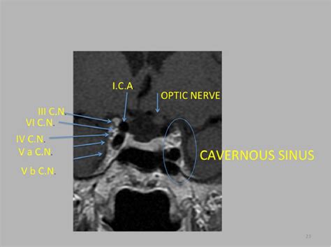 Cavernous Sinus Syndrome: Anatomy and Differential Diagnosis | Semantic ...