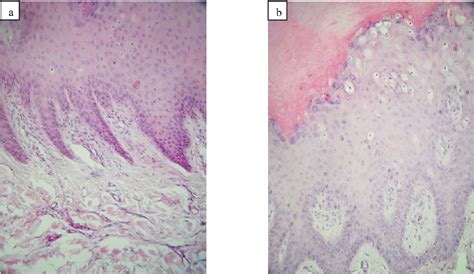 Verruca Vulgaris Histology