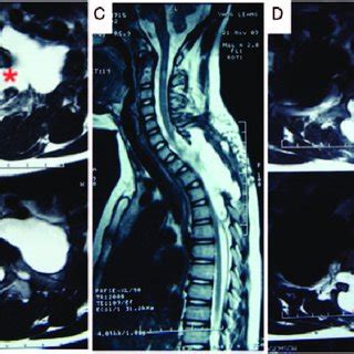 Anterior sacral meningocele in patient 2. Sagittal (A) and axial... | Download Scientific Diagram