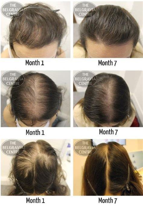 Pin on Hair Loss Treatment