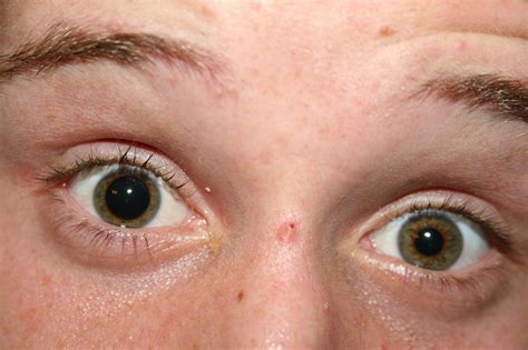 Hyphema: Symptoms, Causes, Classification, Treatment and Prevention - Scope Heal