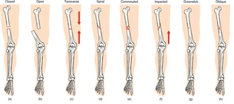 anatomy and physiology bone fractures worksheet | Anatomy Worksheets