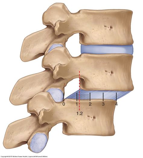 Spondylolisthesis — Experience Physical Therapy - Buffalo Grove, IL