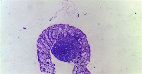 GASTROINTESTINAL AND LIVER HISTOLOGY PATHOLOGY ATLAS: COLON LYMPHOID POLYP