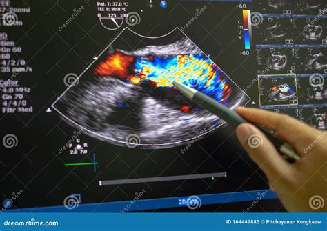 Echocardiography, Ultrasound Of The Heart. Normal Children`s Result Of A Medical Research Method ...