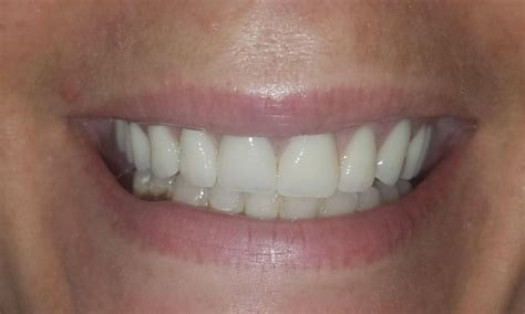 Dentures in New Orleans | Dentures Before and After Photos