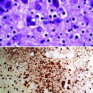 (A) Histopathological findings – neurons of germinal matrix with some ...