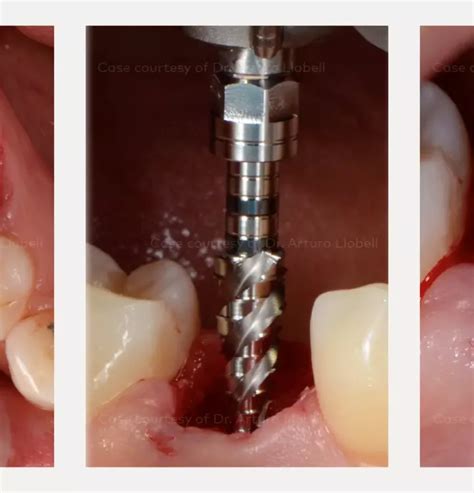 Loading of a Nobel Biocare N1 Implant for a lower molar