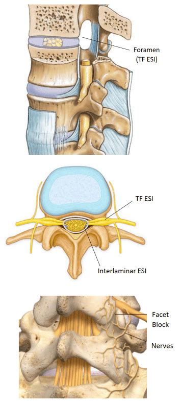 Injection Types - Excel Spine