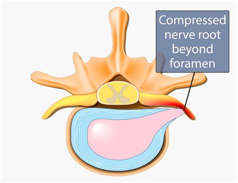 Spinal Stenosis Symptoms, Diagnosis & Treatment | Miami Neuroscience Center