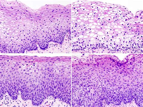 Cervical Intraepithelial Neoplasia