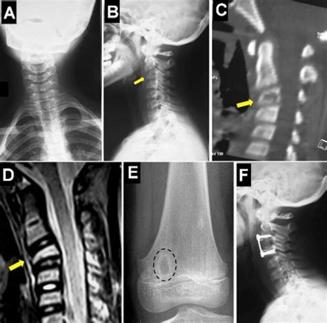 Cervical spine X-rays showing a cervical scoliosis with | Open-i