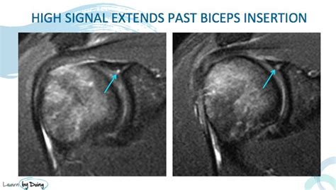 MRI Shoulder SLAP Tears 3 Things to look for - Radedasia