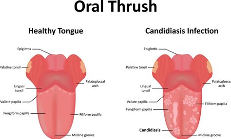 Red Spots On Tongue Std