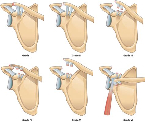 Imaging of the Acromioclavicular Joint: Anatomy, Function, Pathologic Features, and Treatment ...