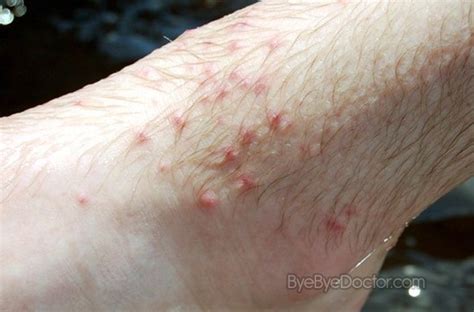 Chigger Bite – Pictures, Symptoms and Treatment