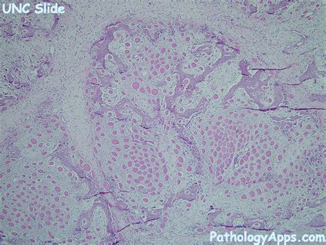 myositis ossificans pathology