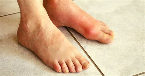 11 Essential Oils For Gout You Should Be Using (+Instructions)