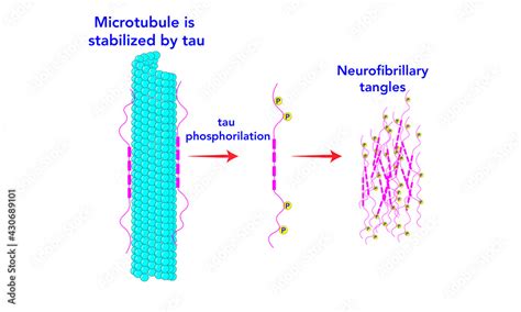 Neurofibrillary tangles [Tau proteins] microtubule Stock Vector | Adobe ...