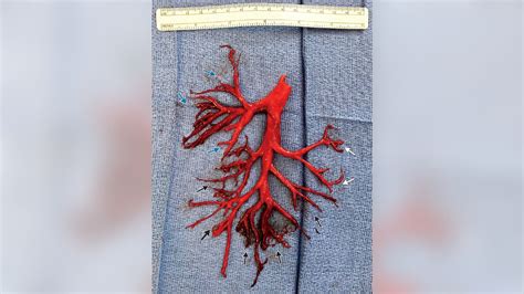 Patient coughs up blood clot in shape of lung passage: report - Family World News